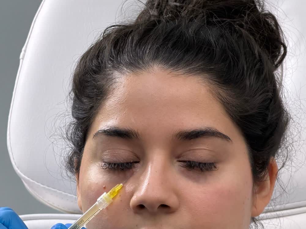 Dermal Fillers at Aterna Wellness