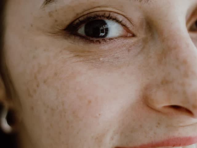 Pigmentation & Redness treatment at Aterna Wellness